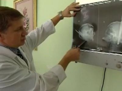В России нейрохирурги извлекли табуретку из головы пациента - В Мире